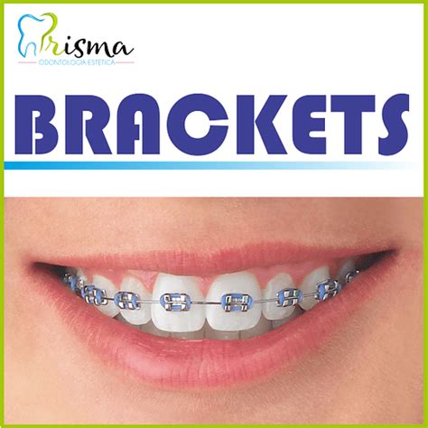 brackets metalicos cali|CLÍNICA DE ORTODONCIA CALI PRISMA.